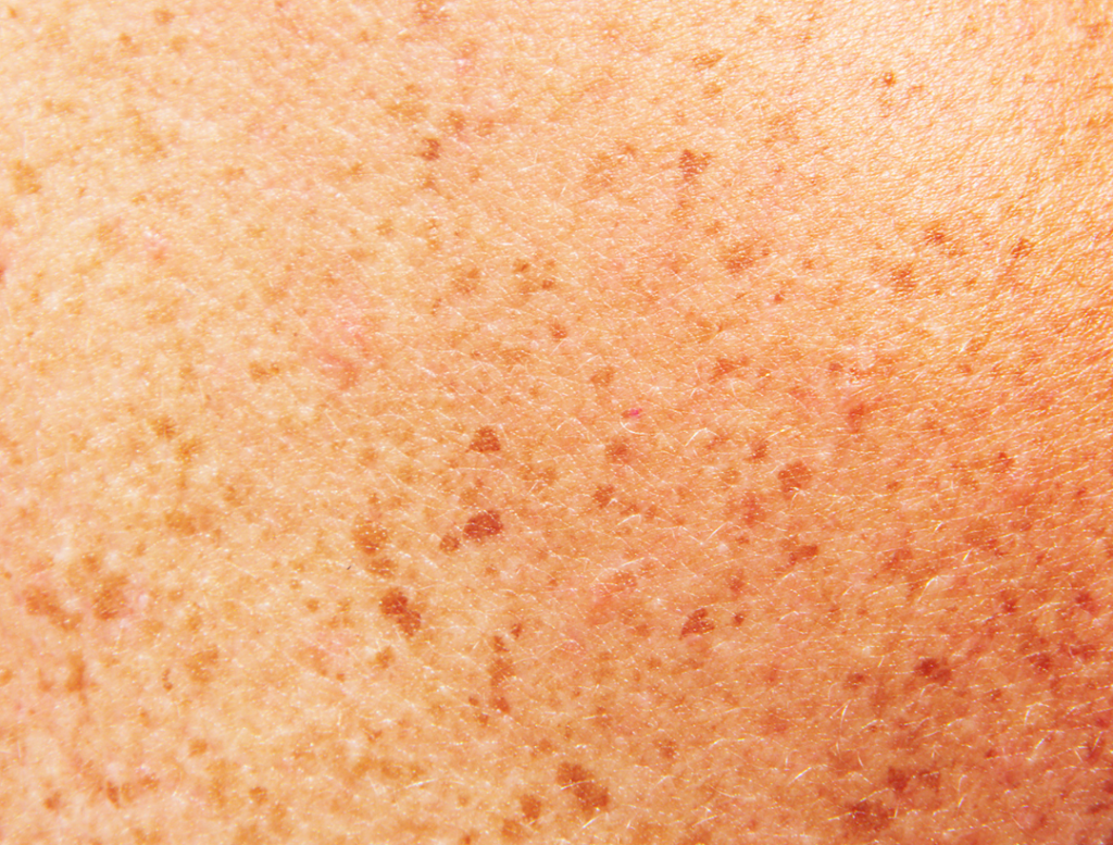 Peau avec taches de rousseurs, grains de beauté et lésions cutanées.