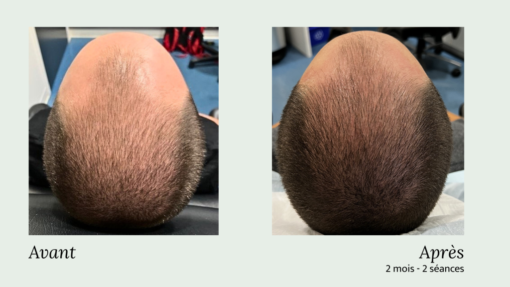 Avant-Après PRP cheveux