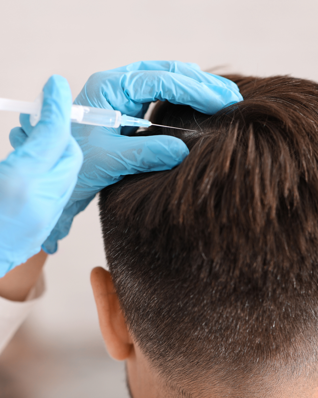 Traitement de PRP dans les cheveux d'un homme de dos.