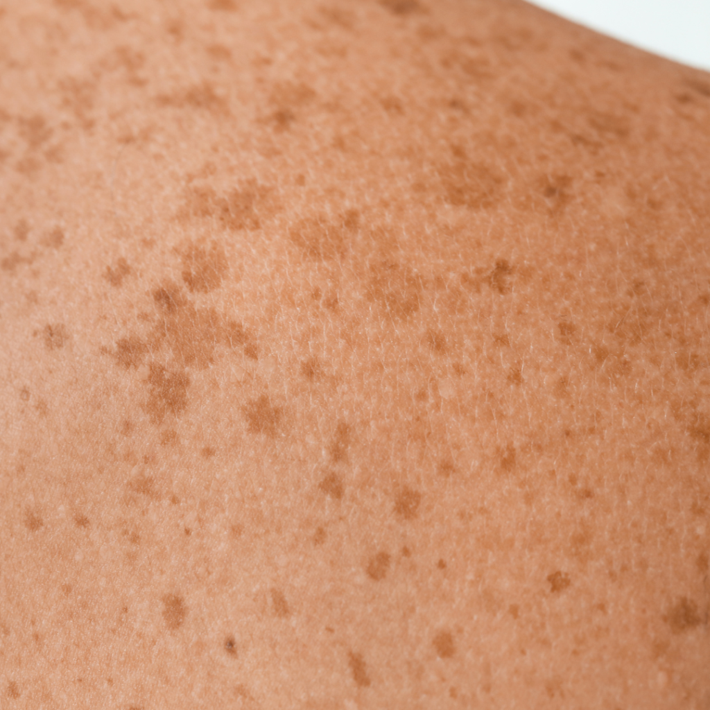 Peau du dos aec taches pigmentaires et dommage solaires